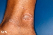 leprosy tuberculoid