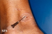 leprosy tuberculoid