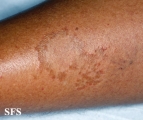 leprosy tuberculoid