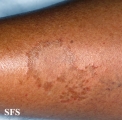 leprosy tuberculoid