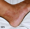 leprosy tuberculoid