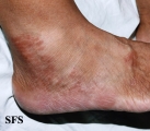 leprosy tuberculoid