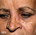 leprosy tuberculoid