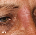 leprosy tuberculoid