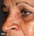 leprosy tuberculoid