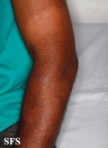 leprosy tuberculoid