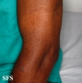 leprosy tuberculoid