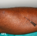 leprosy tuberculoid