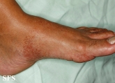 leprosy tuberculoid