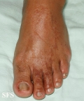 leprosy tuberculoid