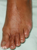 leprosy tuberculoid