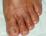 leprosy tuberculoid