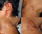 leprosy tuberculoid