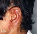 leprosy tuberculoid