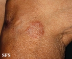 leprosy tuberculoid