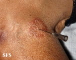 leprosy tuberculoid