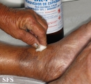leprosy tuberculoid