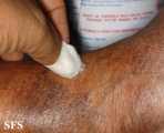 leprosy tuberculoid