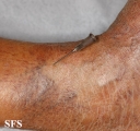 leprosy tuberculoid