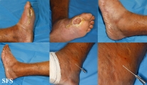 leprosy tuberculoid