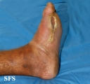 leprosy tuberculoid