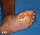 leprosy tuberculoid
