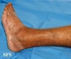 leprosy tuberculoid