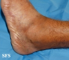 leprosy tuberculoid