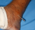 leprosy tuberculoid