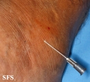 leprosy tuberculoid