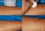 leprosy tuberculoid