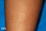 leprosy tuberculoid