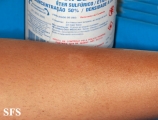 leprosy tuberculoid
