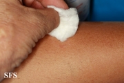 leprosy tuberculoid