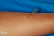 leprosy tuberculoid