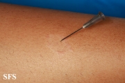 leprosy tuberculoid