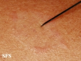 leprosy tuberculoid