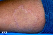 leprosy tuberculoid