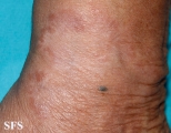 leprosy tuberculoid