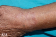 leprosy tuberculoid