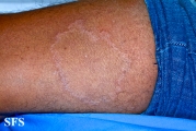 leprosy tuberculoid