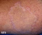 leprosy tuberculoid