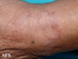leprosy tuberculoid