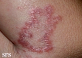 leprosy tuberculoid