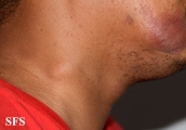 leprosy tuberculoid
