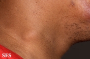 leprosy tuberculoid