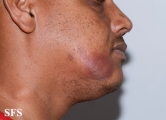 leprosy tuberculoid