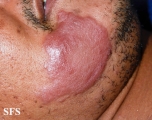 leprosy tuberculoid