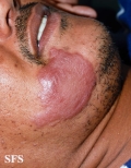 leprosy tuberculoid