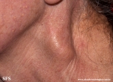 leprosy tuberculoid